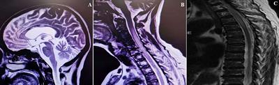 Successful treatment of rituximab-unresponsive elderly-onset neuromyelitis optica spectrum disorder and hypogammaglobulinemia with ofatumumab plus intravenous immunoglobulin therapy in a patient with mutant FCGR3A genotype: A case report